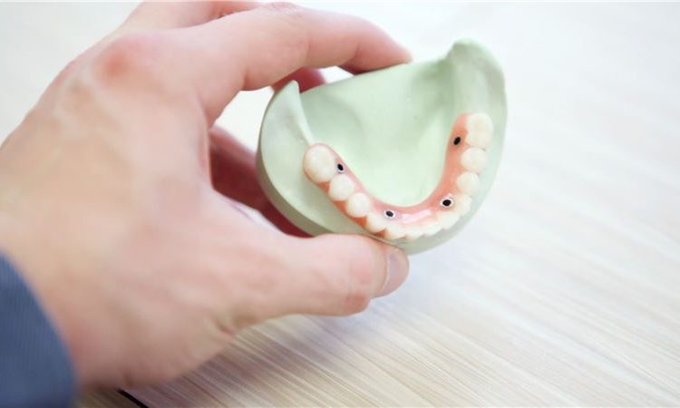 مقایسه ایمپلنت دندان و دندان مصنوعی | بهترین دندانپزشک اصفهان