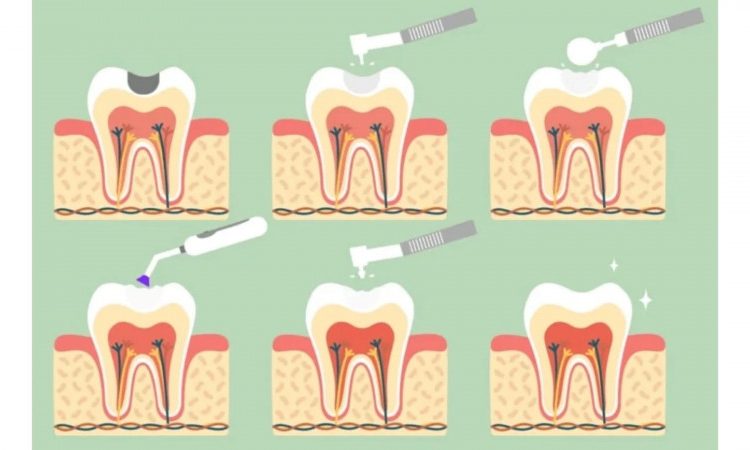Comparaison de l'obturation dentaire avec le composite et l'amalgame | Le meilleur chirurgien des gencives à Ispahan