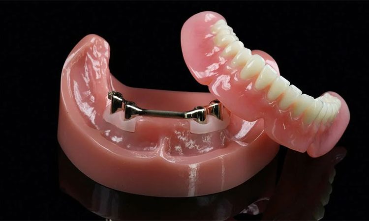 نحوه ساخت پروتزهای دندانی | بهترین ایمپلنت اصفهان
