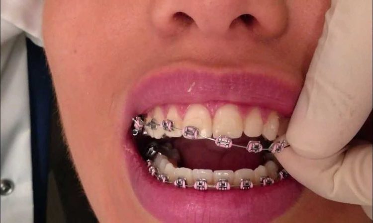پاسخ به سوالات متداول در مورد موم ارتودنسی | بهترین دندانپزشک اصفهان
