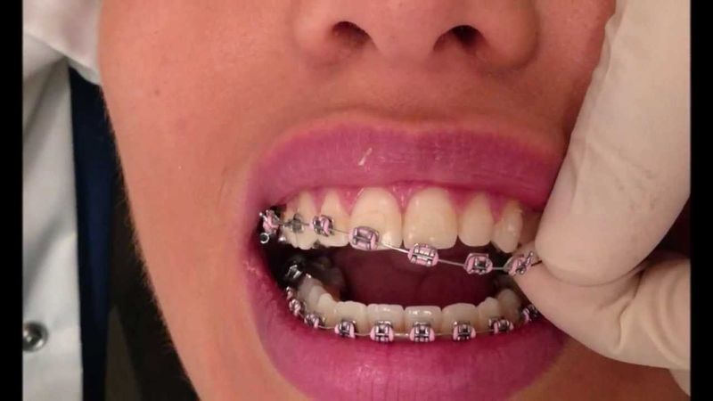 پاسخ به سوالات متداول در مورد موم ارتودنسی | بهترین دندانپزشک اصفهان