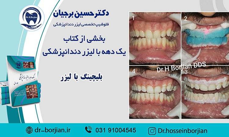بخشی از کتاب یک دهه با لیزر دندانپزشکی ( بلیچینگ با لیزر )|بهترین دندانپزشک اصفهان