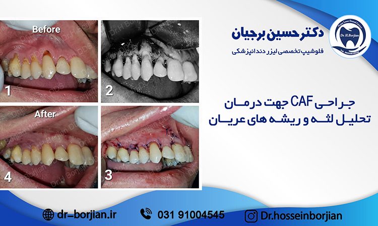 بخشی از کتاب یک دهه با لیزر دندانپزشکی (درمان تحلیل لثه و ریشه های عریان)|بهترین دندانپزشک اصفهان