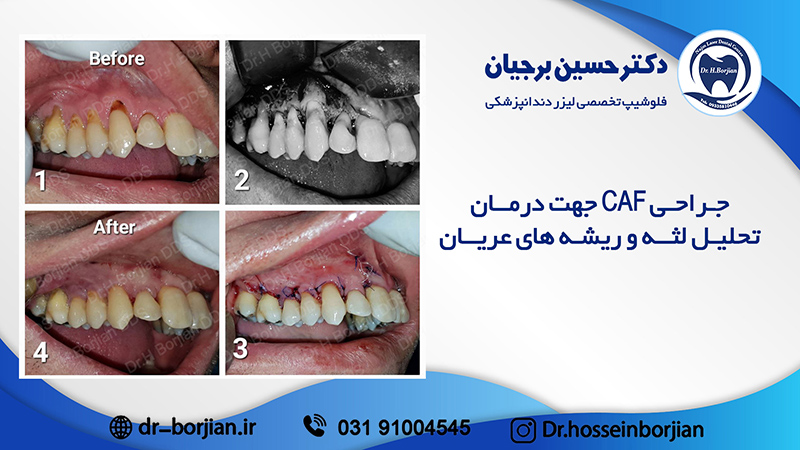 بخشی از کتاب یک دهه با لیزر دندانپزشکی (درمان تحلیل لثه و ریشه های عریان)|بهترین دندانپزشک اصفهان