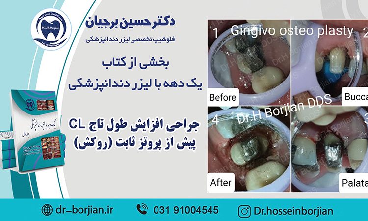بخشی از کتاب یک دهه با لیزر دندانپزشکی (جراحی افزایش طول تاج CL )|بهترین دندانپزشک اصفهان