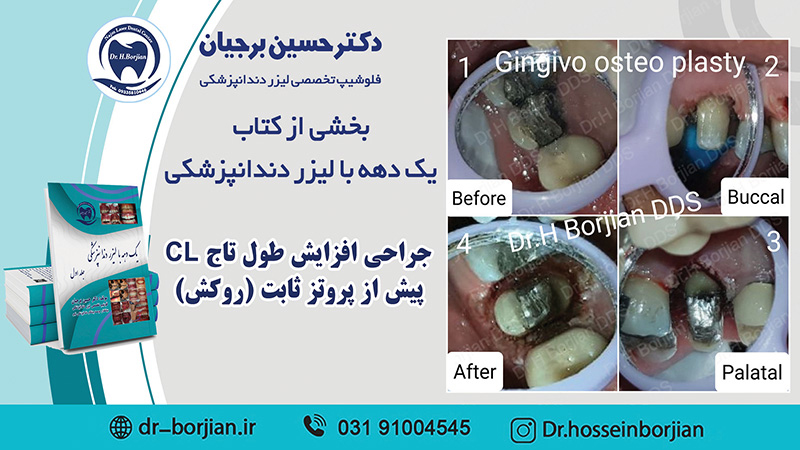 بخشی از کتاب یک دهه با لیزر دندانپزشکی (جراحی افزایش طول تاج CL )|بهترین دندانپزشک اصفهان