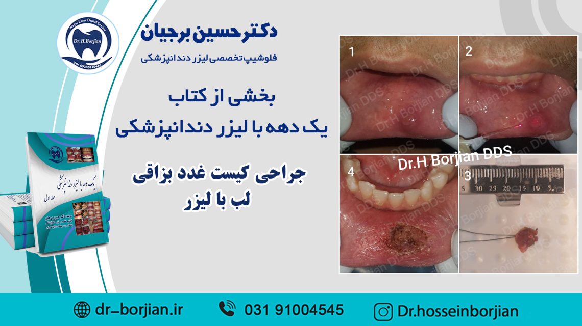 بخشی از کتاب یک دهه با لیزر دندانپزشکی (جراحی کیست غدد بزاقی لب با لیزر) |بهترین دندانپزشک اصفهان