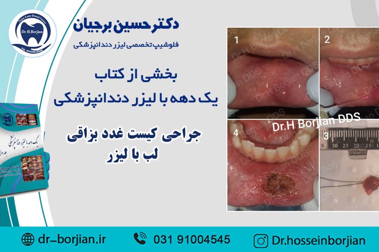 بخشی از کتاب یک دهه با لیزر دندانپزشکی (جراحی کیست غدد بزاقی لب با لیزر) |بهترین دندانپزشک اصفهان