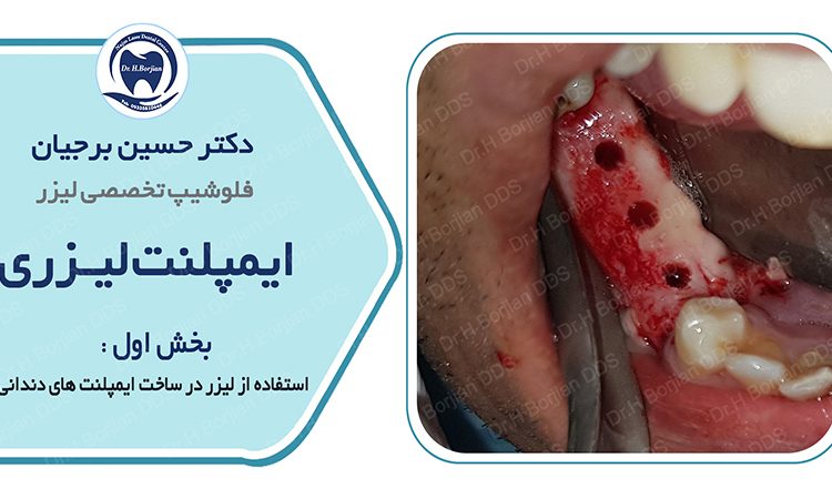 Laser implant 1) The use of lasers in making dental implants|The best dentist in Isfahan