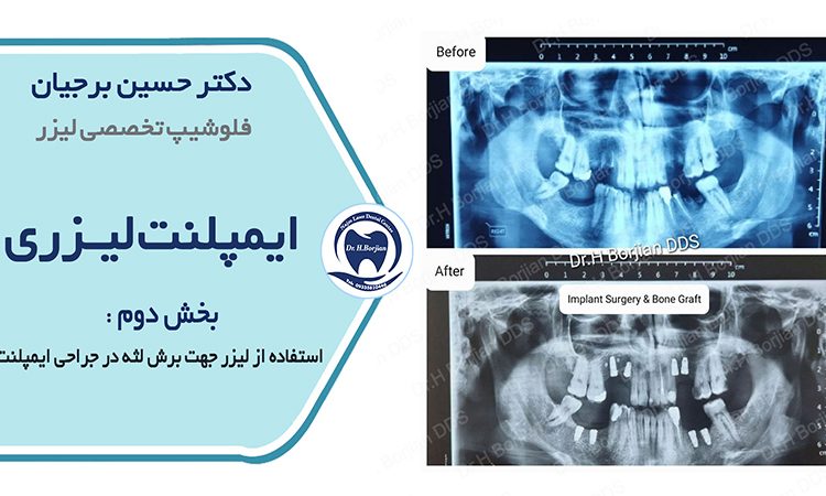زرع الليزر 2) استخدام الليزر لقطع اللثة في الغرسات| افضل دكتور اسنان في اصفهان