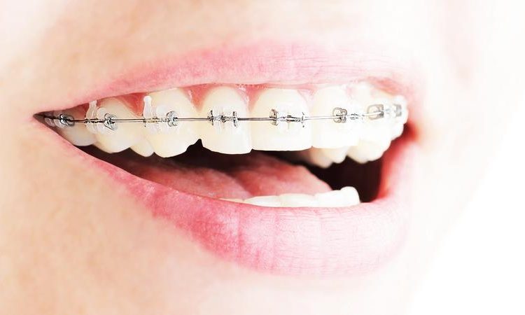 Familiarity with functional orthodontics | The best gum surgeon in Isfahan