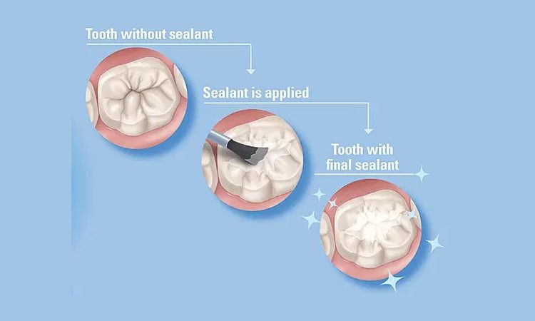 آنچه باید در مورد فیشور سیلانت دندان بدانید | بهترین جراح لثه اصفهان