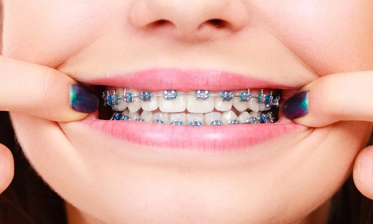 Emergency procedures during orthodontics | The best cosmetic dentist in Isfahan