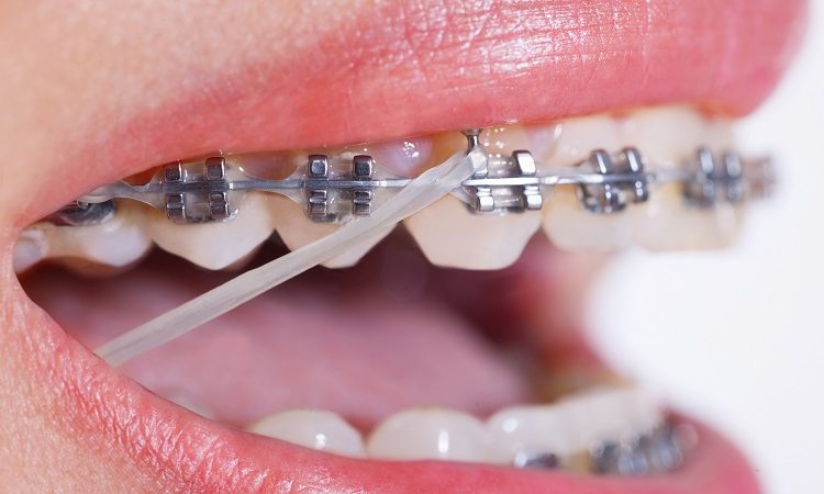انواع ارتودنسی کاموفلاژ یا جبرانی | بهترین دندانپزشک زیبایی اصفهان