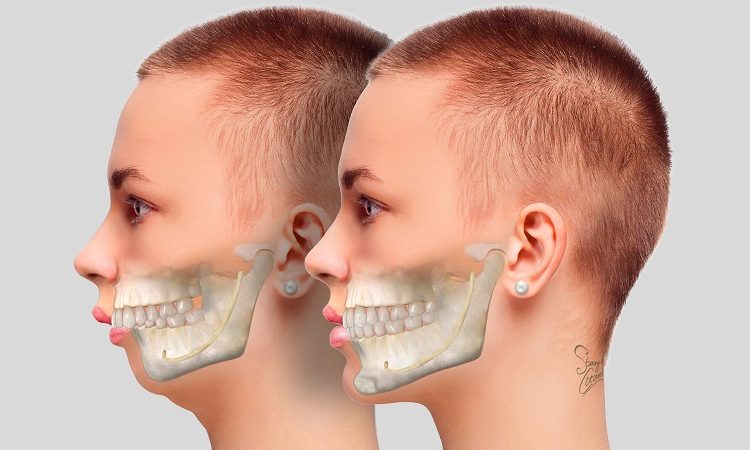 Different types of jaw abnormalities | The best gum surgeon in Isfahan