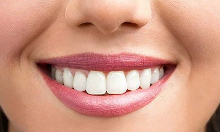 مراجعة قشرة الأسنان Lumineers | أفضل جراح لثة في اصفهان