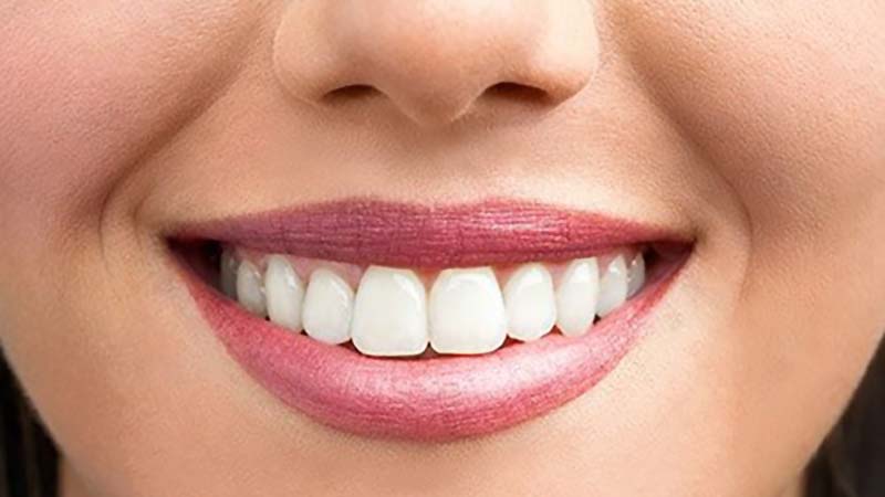 بررسی ونیرهای دندانی لومینیرز | بهترین جراح لثه اصفهان