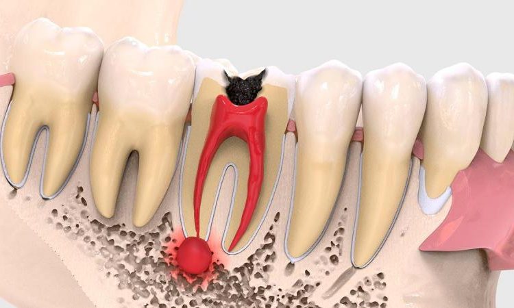 Diagnosing the symptoms of all types of dental cysts | The best gum surgeon in Isfahan