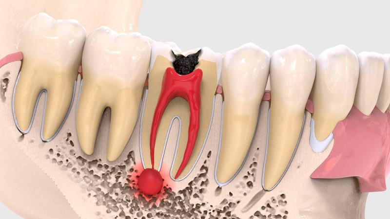 تشخیص علائم انواع کیست‌های دندان | بهترین جراح لثه اصفهان