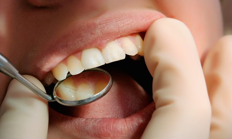 دلیل انواع لکه های سفید (فلورسیس) روی دندان کودکان | بهترین دندانپزشک زیبایی اصفهان