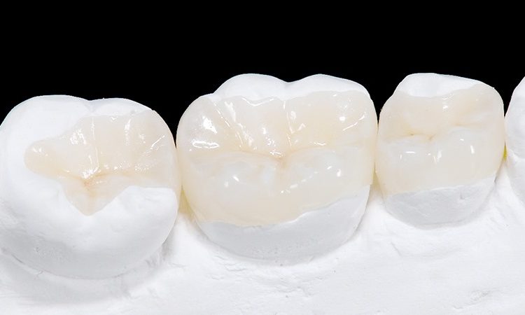 طرق ترميم الأسنان غير المباشرة | افضل دكتور اسنان في اصفهان