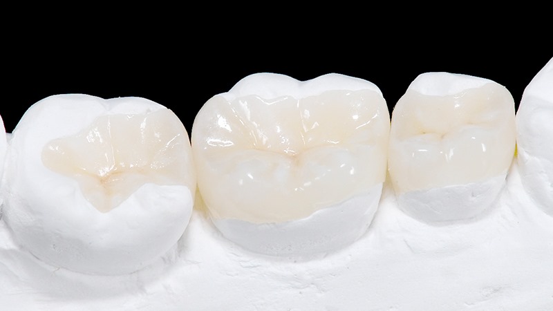 روش های ترمیم غیر مستقیم دندان | بهترین دندانپزشک اصفهان