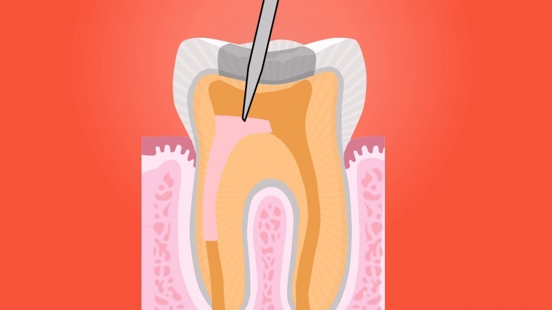 روش های ترمیم مستقیم دندان | بهترین دندانپزشک اصفهان