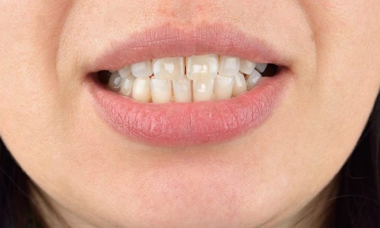 روش های پیشگیری و درمان لکه سفید روی دندان | بهترین ایمپلنت اصفهان