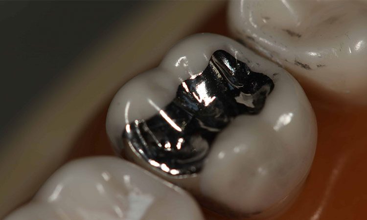 Raisons de remplacer l'amalgame par un composite | Le meilleur dentiste d'Ispahan