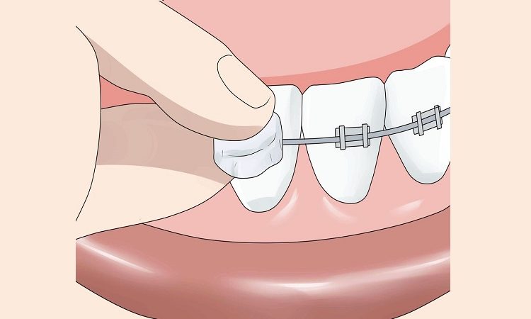 Procédures d'utilisation de la cire orthodontique | Le meilleur chirurgien des gencives à Ispahan