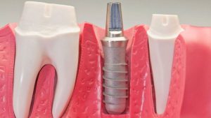 Procédures chirurgicales d'implants dentaires | Le meilleur dentiste d'Ispahan