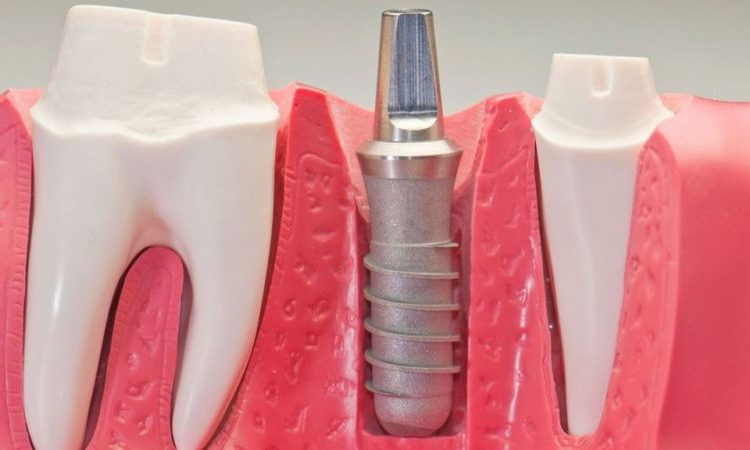 Dental implant surgical procedures | The best dentist in Isfahan