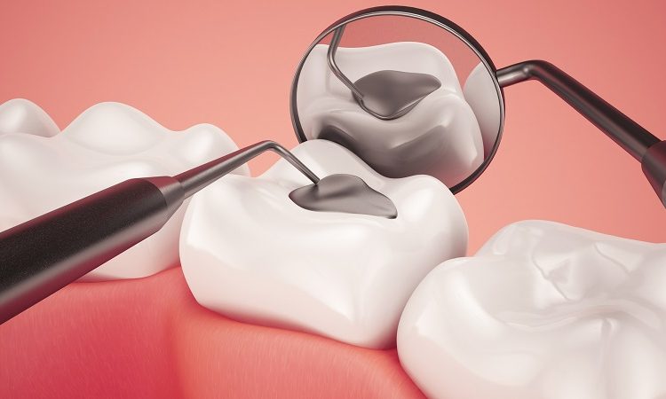 مراحل پر کردن دندان با کامپوزیت و آمالگام | بهترین ایمپلنت اصفهان