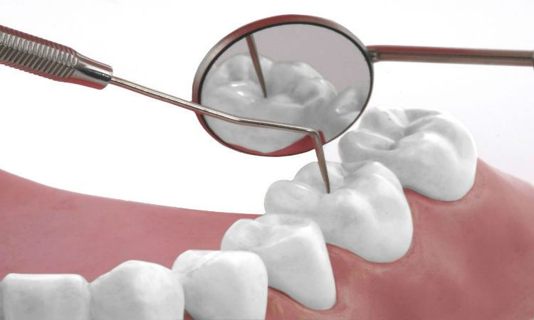 پاسخ به پرسش هایی در مورد پرکردن دندان | بهترین دندانپزشک اصفهان