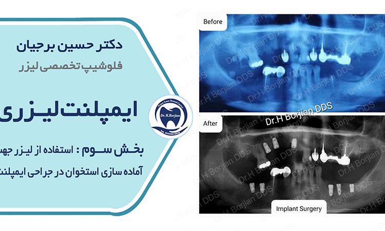 Laser implant 3) Use of laser for bone preparation|The best implant in Isfahan