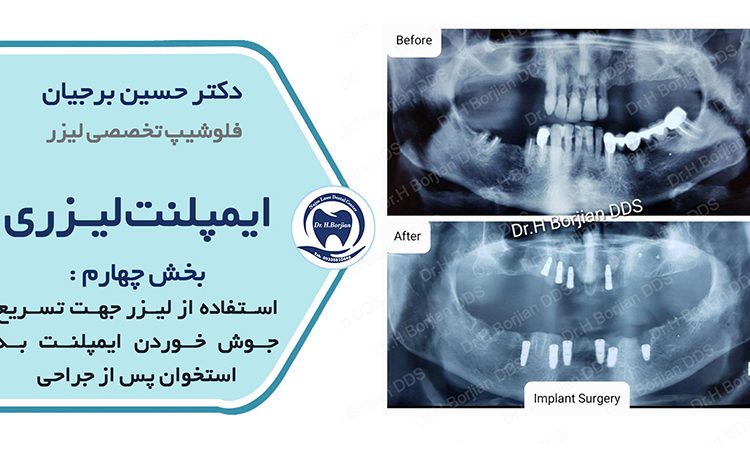 Implant laser | Le meilleur dentiste d'Ispahan
