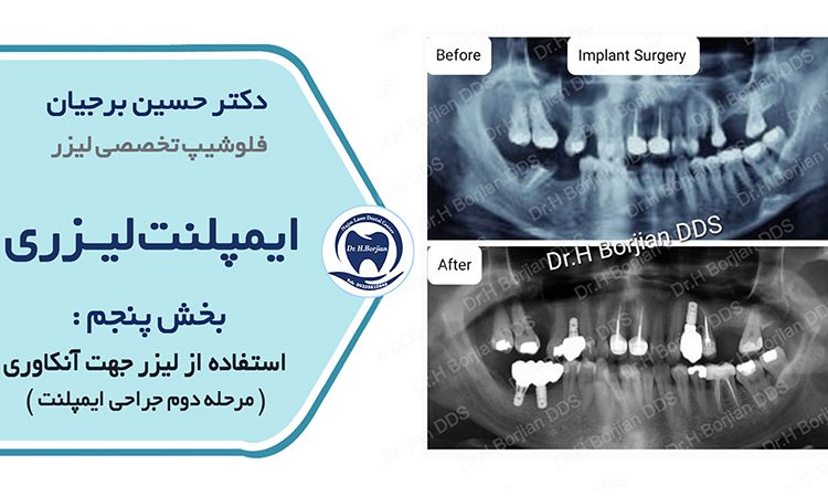 Laser implant | The best dentist in Isfahan