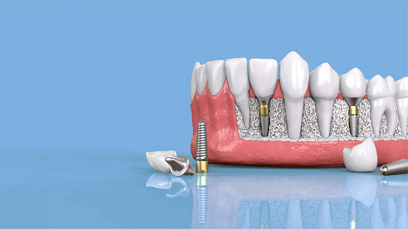 ماندگاری ایمپلنت دندان | بهترین جراح لثه اصفهان