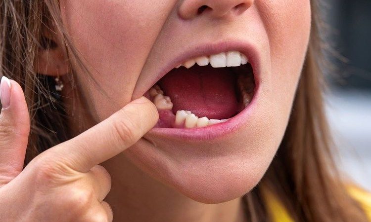 روشهای درمانی برای لق شدن دندان دائمی | بهترین ایمپلنت اصفهان