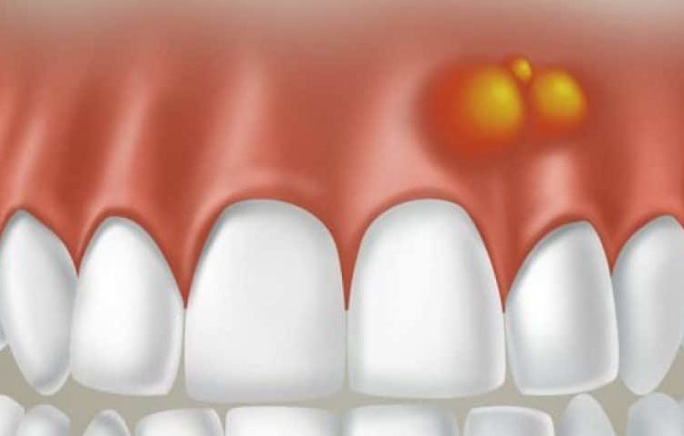 Traitement médical des abcès dentaires et gingivaux | Le meilleur implant à Ispahan