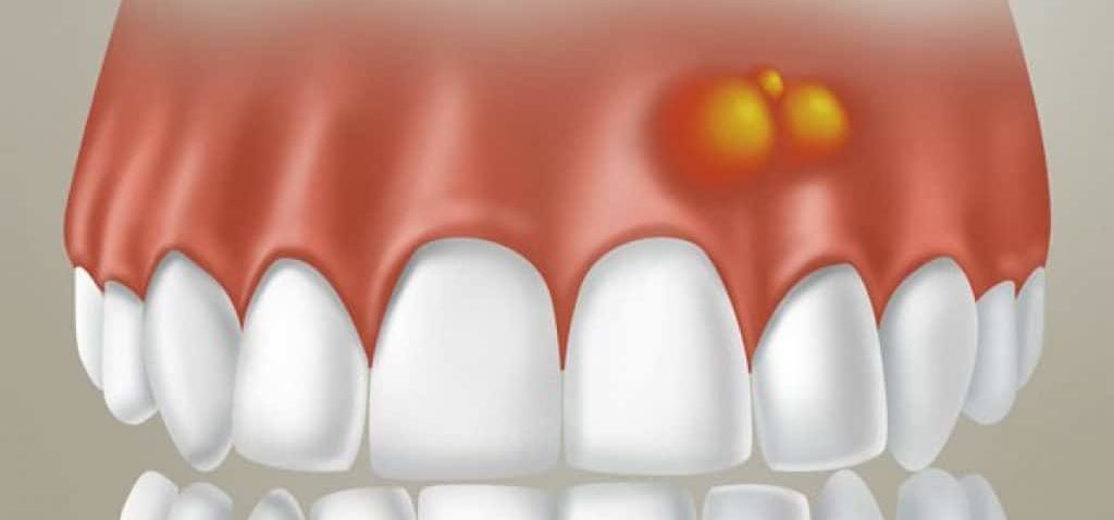 درمان پزشکی آبسه دندان و لثه | بهترین ایمپلنت اصفهان