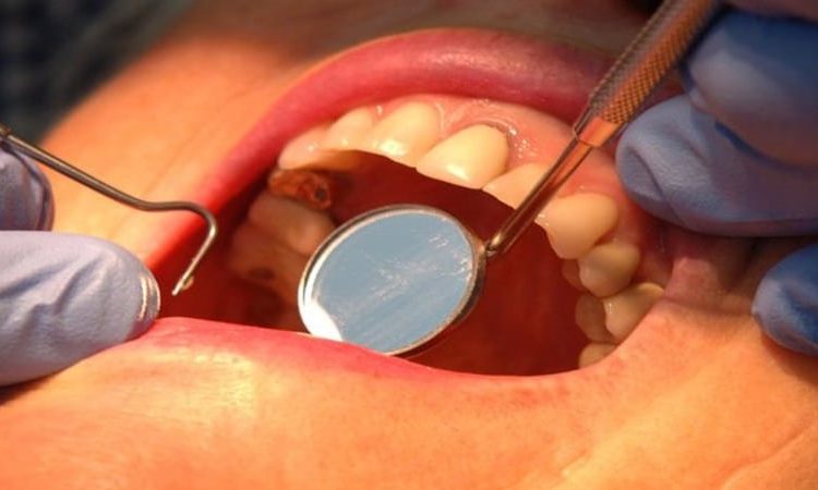 طرق إصلاح وعلاج الأسنان التالفة | أفضل جراح لثة في اصفهان
