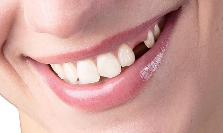 Ways to replace adjacent teeth | The best dentist in Isfahan