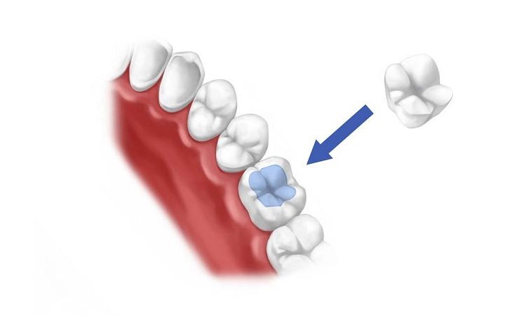 روش های ترمیم غیر مستقیم دندان | بهترین دندانپزشک اصفهان