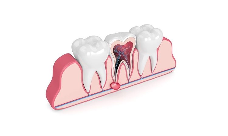 طرق علاج كيس اللثة والأسنان | افضل دكتور اسنان تجميلي في اصفهان