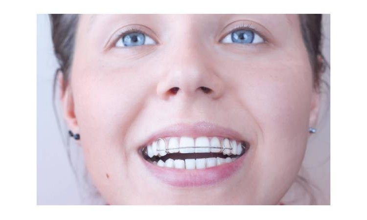 Avantages et inconvénients de l'utilisation de l'orthodontie fonctionnelle | Le meilleur implant à Ispahan