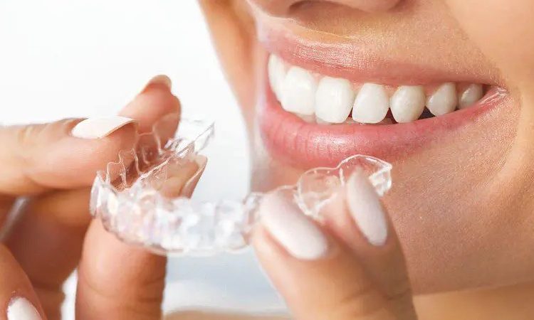 Présentation des types de protection dentaire | Le meilleur dentiste d'Ispahan