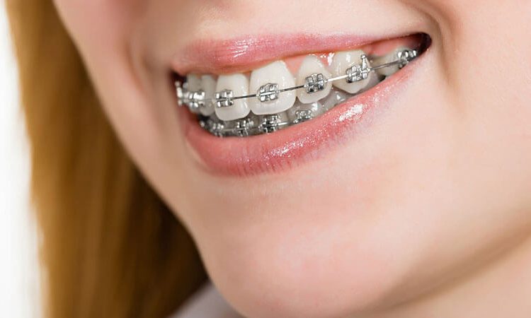 Introducing common functional orthodontic devices | The best cosmetic dentist in Isfahan