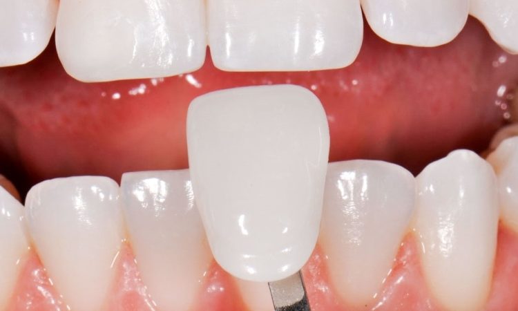 Comparing the differences between luminaries and dental laminates | The best cosmetic dentist in Isfahan