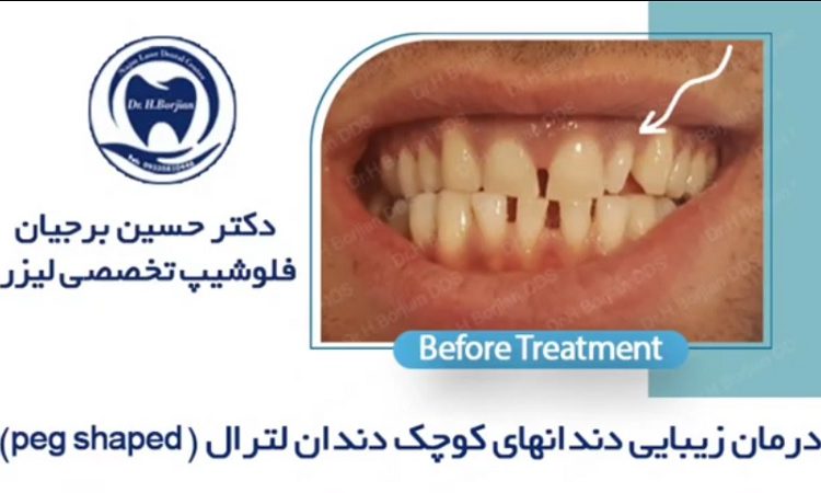 نمونه درمان زیبایی دندان های کوچک لترال